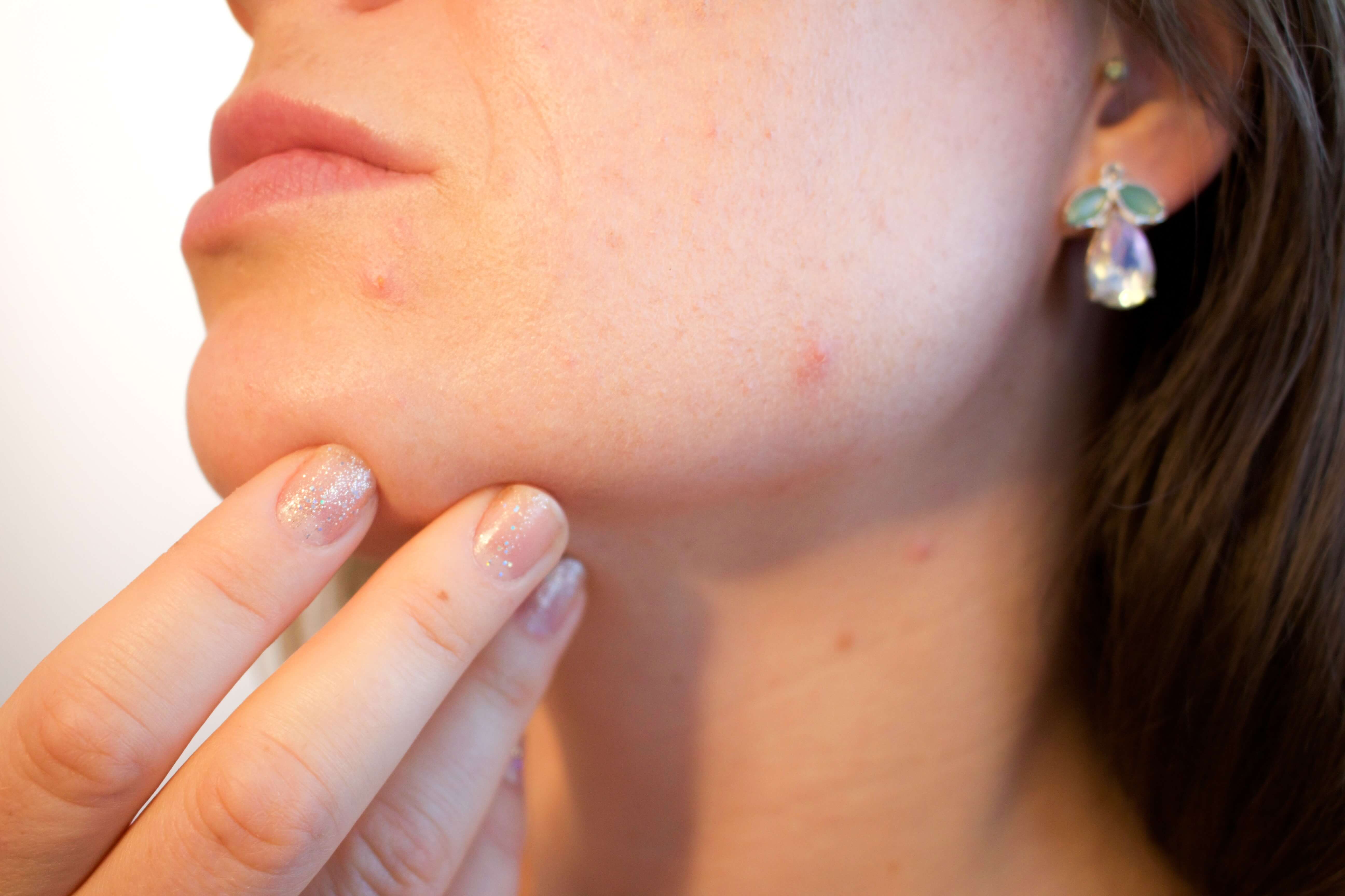 5 Simple Ways To Treat Acne Scars Naturally Fashion Food - 